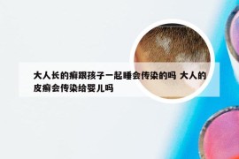 大人长的癣跟孩子一起睡会传染的吗 大人的皮癣会传染给婴儿吗