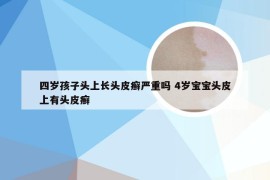 四岁孩子头上长头皮癣严重吗 4岁宝宝头皮上有头皮癣