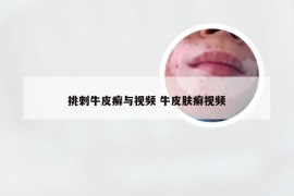 挑刺牛皮癣与视频 牛皮肤癣视频