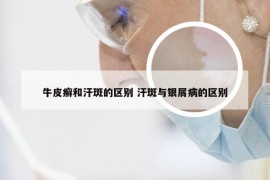 牛皮癣和汗斑的区别 汗斑与银屑病的区别