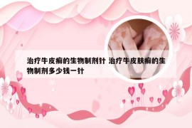 治疗牛皮癣的生物制剂针 治疗牛皮肤癣的生物制剂多少钱一针