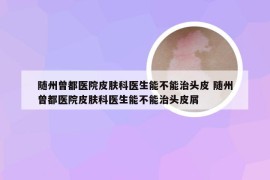 随州曾都医院皮肤科医生能不能治头皮 随州曾都医院皮肤科医生能不能治头皮屑