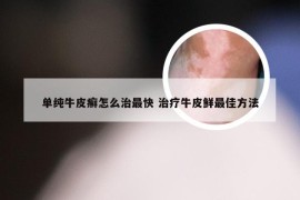 单纯牛皮癣怎么治最快 治疗牛皮鲜最佳方法