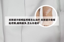 皮肤遇冷就痒起疙瘩怎么治疗 皮肤遇冷瘙痒起疙瘩,越抓越多,怎么办是好