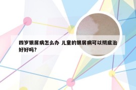 四岁银屑病怎么办 儿童的银屑病可以彻底治好好吗?
