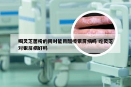 喝灵芝菌粉的同时能用醋擦银屑病吗 吃灵芝对银屑病好吗