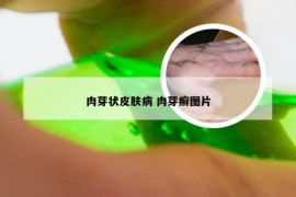 肉芽状皮肤病 肉芽癣图片