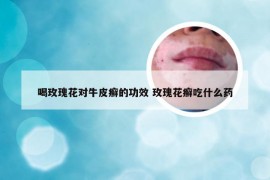 喝玫瑰花对牛皮癣的功效 玫瑰花癣吃什么药