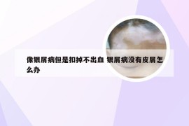 像银屑病但是扣掉不出血 银屑病没有皮屑怎么办