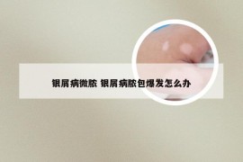 银屑病微脓 银屑病脓包爆发怎么办