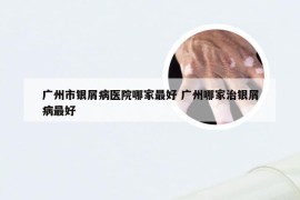广州市银屑病医院哪家最好 广州哪家治银屑病最好