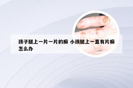 孩子腿上一片一片的癣 小孩腿上一直有片癣怎么办