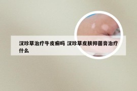 汉珍草治疗牛皮癣吗 汉珍草皮肤抑菌膏治疗什么