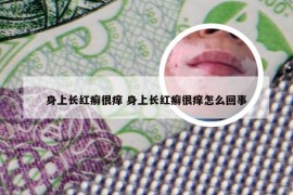 身上长红癣很痒 身上长红癣很痒怎么回事