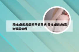 异维a酸软胶囊用于银屑病 异维a酸软胶囊治银屑病吗