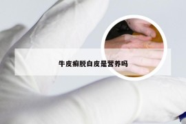 牛皮癣脱白皮是营养吗
