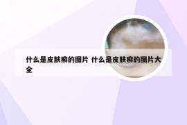 什么是皮肤癣的图片 什么是皮肤癣的图片大全