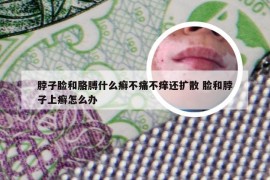 脖子脸和胳膊什么癣不痛不痒还扩散 脸和脖子上癣怎么办