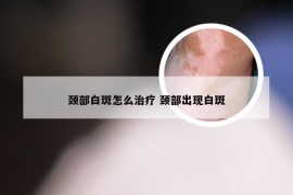 颈部白斑怎么治疗 颈部出现白斑