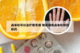 卤米松可以治疗银宵病 银屑病用卤米松如何停药