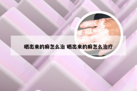 晒出来的癣怎么治 晒出来的癣怎么治疗