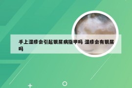 手上湿疹会引起银屑病指甲吗 湿疹会有银屑吗