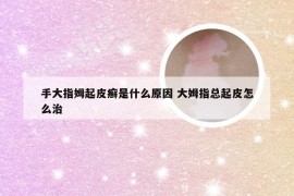 手大指姆起皮癣是什么原因 大姆指总起皮怎么治
