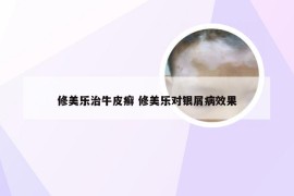 修美乐治牛皮癣 修美乐对银屑病效果