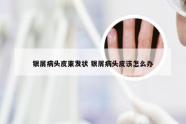 银屑病头皮束发状 银屑病头皮该怎么办