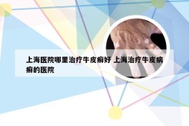 上海医院哪里治疗牛皮癣好 上海治疗牛皮病癣的医院