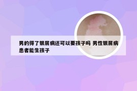 男的得了银屑病还可以要孩子吗 男性银屑病患者能生孩子