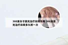 308准分子激光治疗白斑效果 308准激光治疗白斑多久照一次