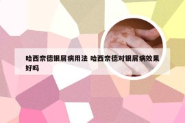哈西奈德银屑病用法 哈西奈德对银屑病效果好吗