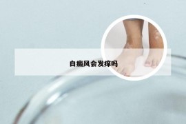 白癜风会发痒吗