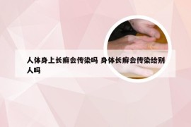 人体身上长癣会传染吗 身体长癣会传染给别人吗