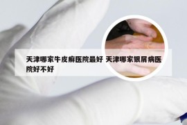 天津哪家牛皮癣医院最好 天津哪家银屑病医院好不好