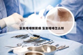 氢氯噻嗪银屑病 氢氯噻嗪怎么样