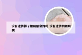没有遗传得了银屑病会好吗 没有遗传的银屑病