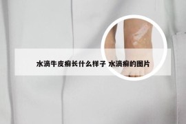 水滴牛皮癣长什么样子 水滴癣的图片