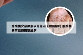 醋酸曲安奈尿素软膏能治了银屑病吗 醋酸曲安奈德搽剂银屑病