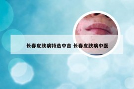 长春皮肤病特选中吉 长春皮肤病中医