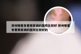 郑州哪里有看银屑病的医院比较好 郑州哪里有看银屑病的医院比较好的