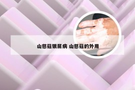 山慈菇银屑病 山慈菇的外用