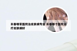 长春哪家医院治皮肤病专业 长春哪个医院治疗皮肤病好