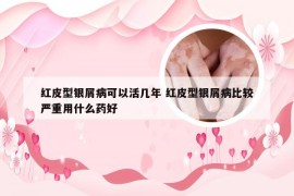 红皮型银屑病可以活几年 红皮型银屑病比较严重用什么药好