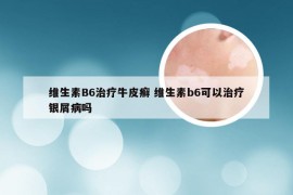 维生素B6治疗牛皮癣 维生素b6可以治疗银屑病吗