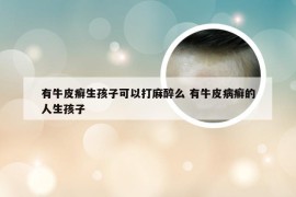 有牛皮癣生孩子可以打麻醉么 有牛皮病癣的人生孩子