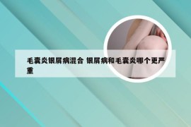 毛囊炎银屑病混合 银屑病和毛囊炎哪个更严重