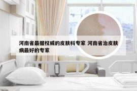 河南省最据权威的皮肤科专家 河南省治皮肤病最好的专家