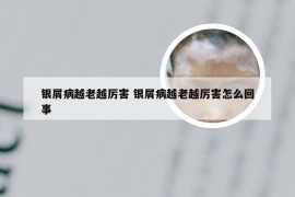 银屑病越老越厉害 银屑病越老越厉害怎么回事